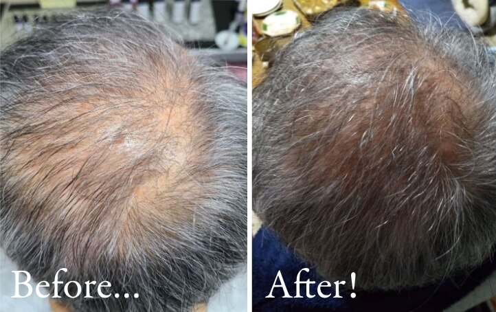 Before→After 薄毛に悩む男性の経過（個人差があります）※育毛をお約束するものではありません。